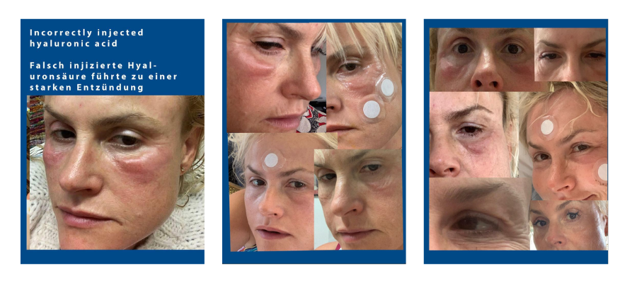 Facial inflammation healing progression photos